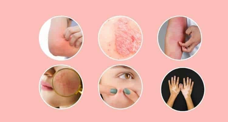 Ayurvedic-Treatment-for-skin-diseases